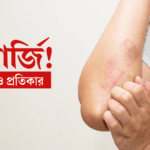 এলার্জির লক্ষণ ও প্রতিকার: বর্তমান সময়ে কেন বাড়ছে এবং কীভাবে নিয়ন্ত্রণ করবেন
