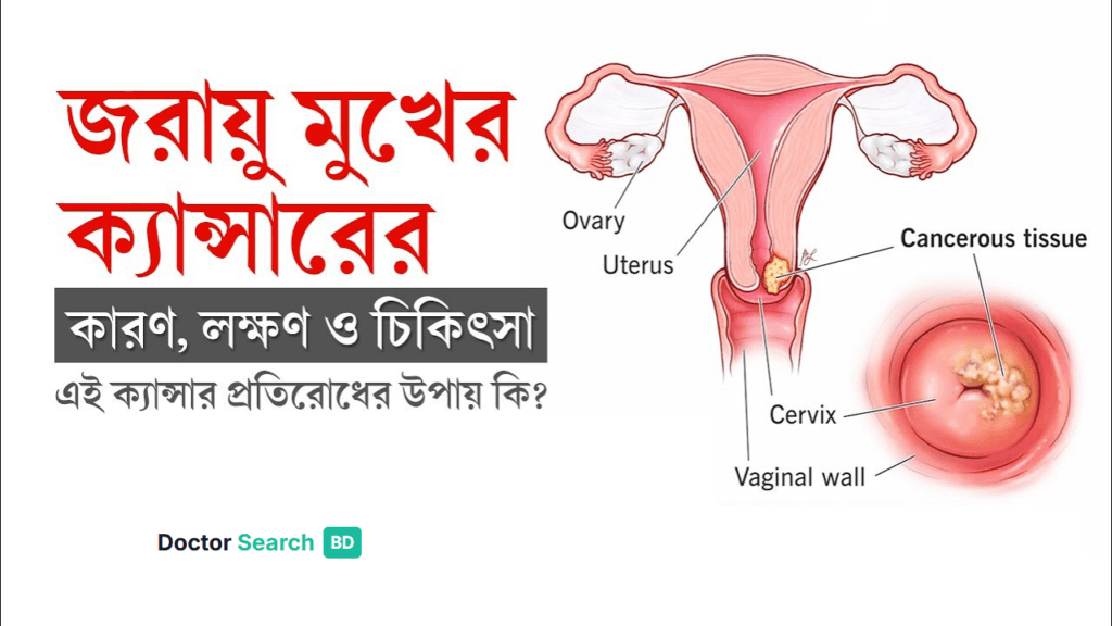 জরায়ু মুখের ক্যান্সারের কারণ, লক্ষণ ও চিকিৎসা: একটি পূর্ণাঙ্গ গাইডলাইন