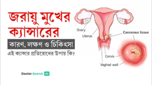 জরায়ু মুখের ক্যান্সারের কারণ, লক্ষণ ও চিকিৎসা: একটি পূর্ণাঙ্গ গাইডলাইন