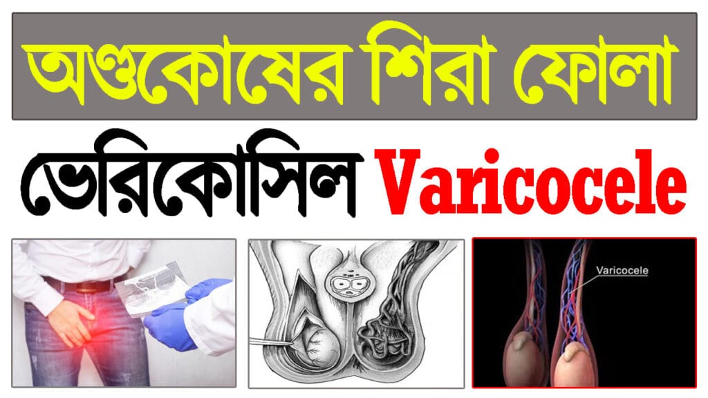 Varicocele কী? লক্ষণ, কারণ, রোগ নির্ণয়, চিকিৎসা ও প্রতিরোধ সম্পর্কে বিস্তারিত