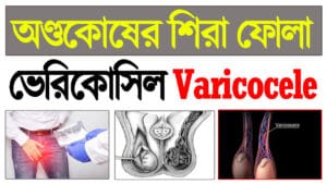 Varicocele কী? লক্ষণ, কারণ, রোগ নির্ণয়, চিকিৎসা ও প্রতিরোধ সম্পর্কে বিস্তারিত